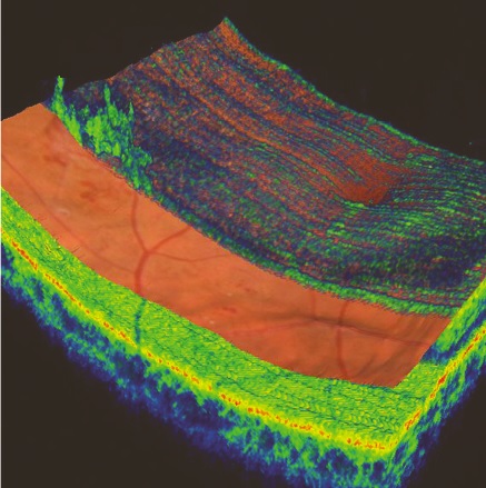 Cross section of 3d scan showing diabetic retinopathy