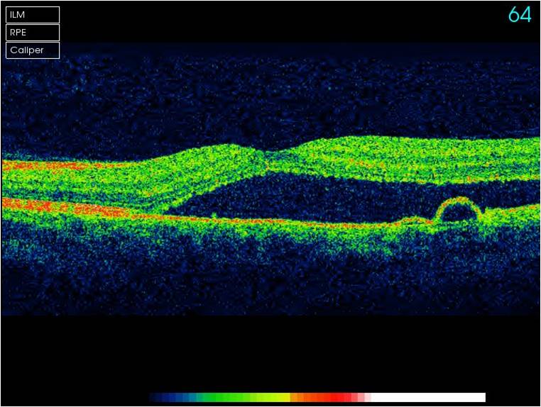 3d scan of the eye showing age-related macular degeneration
